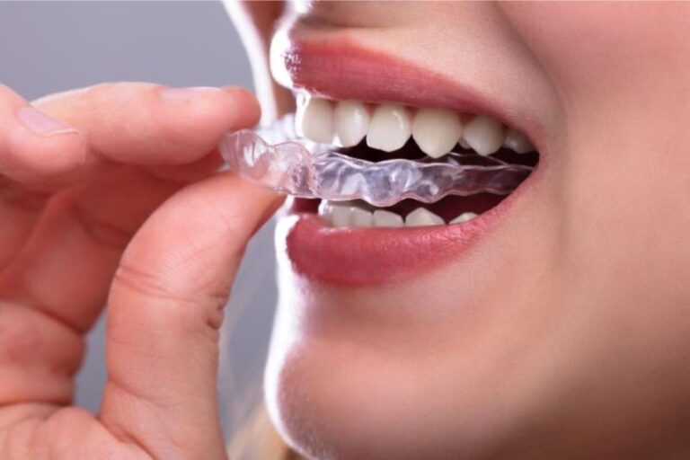 Invisalign Alternatives